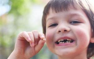 تفسير حلم سقوط الأسنان الأمامية في المنام