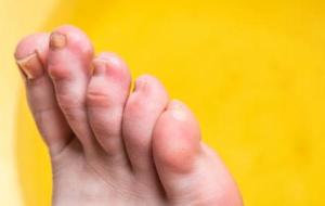 كيفية علاج تورم أصبع القدم الكبير
