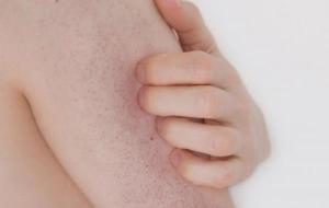 طريقة علاج جلد الوزة