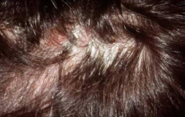 أعراض التهاب بصيلات الشعر وعلاجه