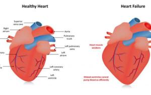 التهاب جدار القلب