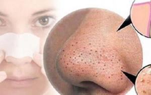 كيفية إزالة البقع السوداء من الوجه بطريقة طبيعية