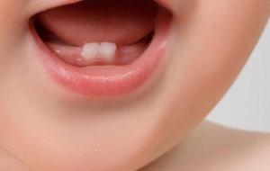 بروز الأسنان لدى الأطفال
