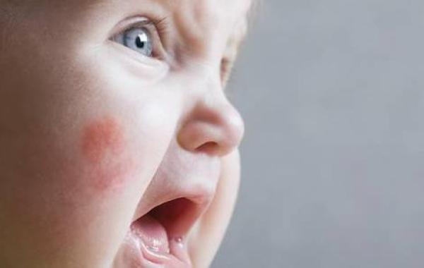أسباب ظهور حساسية الجلد عند الأطفال