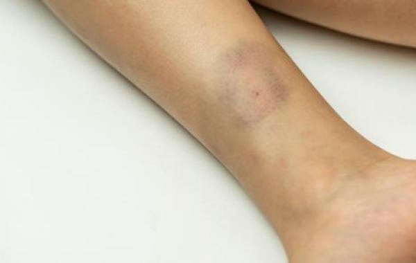 أسباب كدمات الساق عند الأطفال