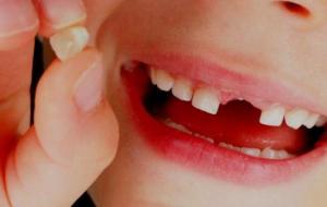 كم عدد الأسنان اللبنية عند الأطفال