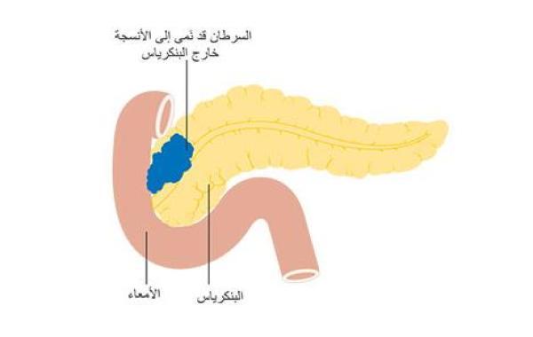 أورام البنكرياس