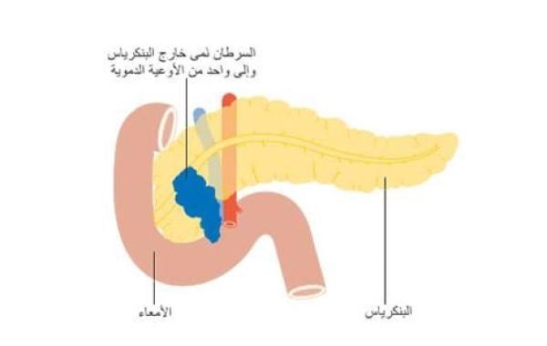 أورام البنكرياس وأعراضه