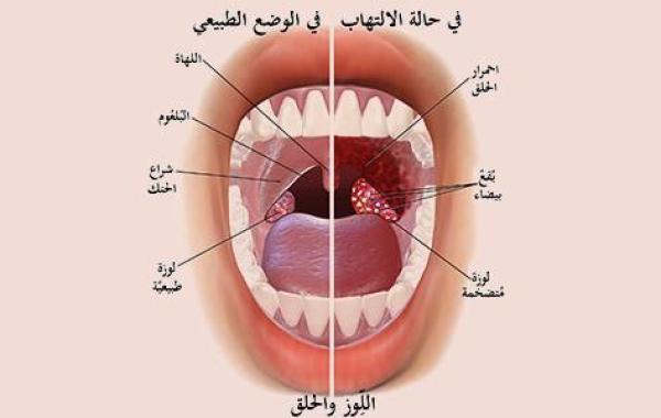 أورام الغدد اللعابية