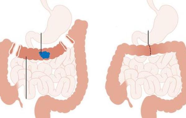 أورام المستقيم وأعراضها