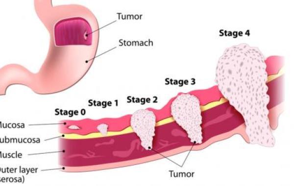 سرطان المعدة وأعراضه