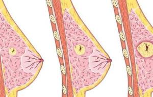 شكل الورم السرطاني في الثدي