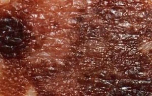 أسباب سرطان الجلد