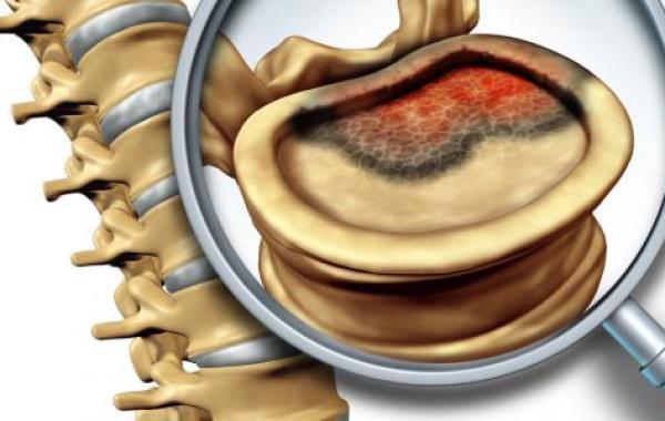 أعراض سرطان فقرات العمود الفقري