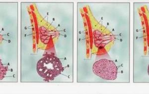 مراحل تطور سرطان الثدي