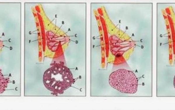 مراحل تطور سرطان الثدي