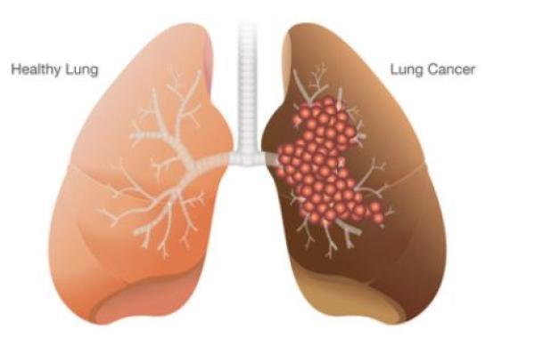 مراحل تطور مرض سرطان الرئة