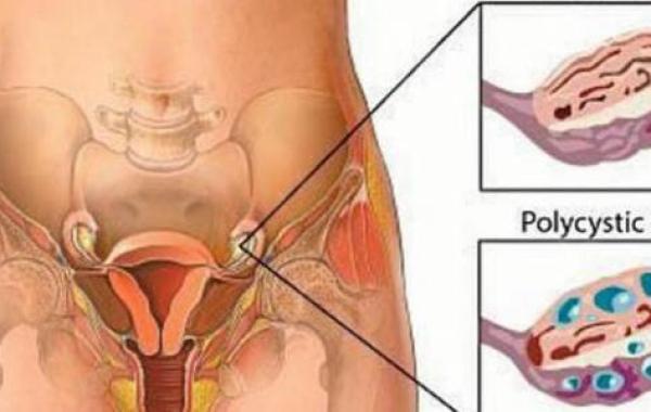 كيف يتم علاج تكيس المبايض