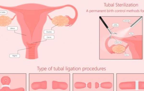 كيفية ربط الرحم لمنع الحمل