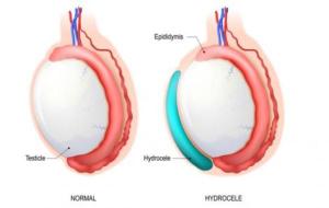 أمراض الخصيتين عند الرجل