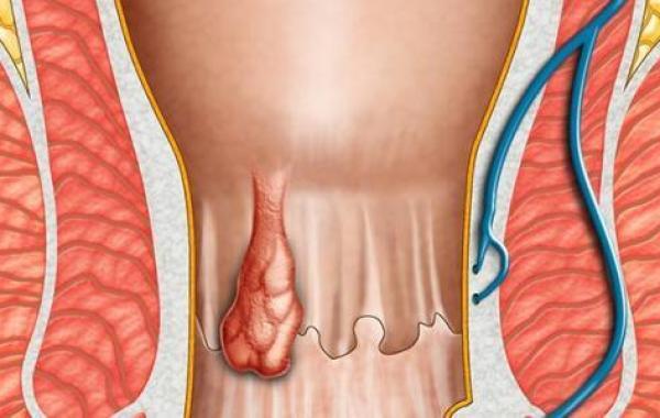 أسباب البواسير عند الرجال