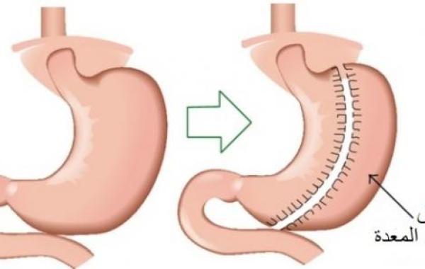 أضرار عملية تكميم المعدة