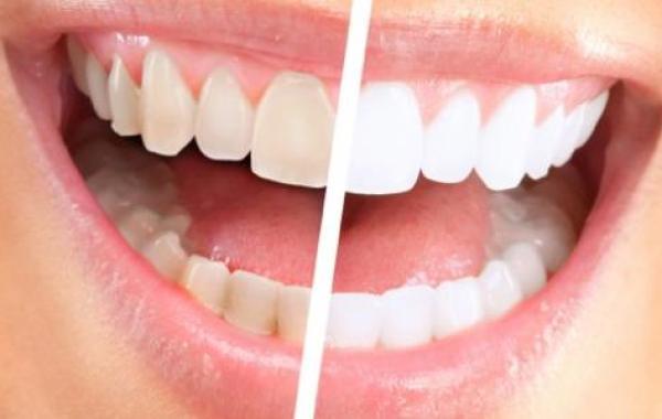 هل إزالة الجير من الأسنان مؤلم