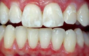 البقع البيضاء في الأسنان