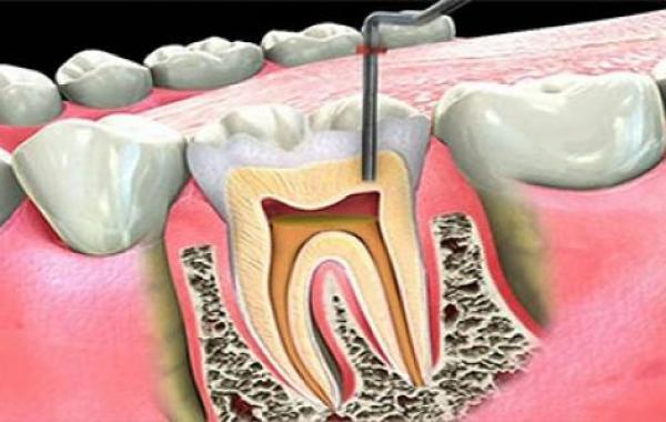 علاج التهاب عصب الأسنان