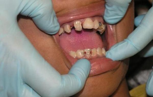 علاج تسوس الأسنان الأمامية