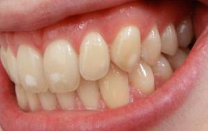 ما سبب ظهور بقع بيضاء على الأسنان