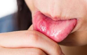 ما علاج فطريات الفم