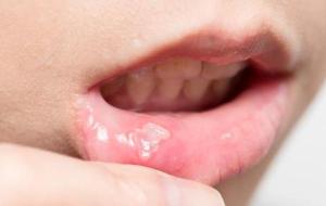 ما هي أعراض فطريات الفم