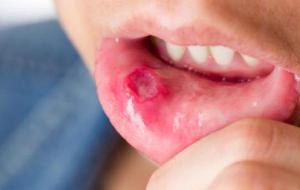 ما هي أنواع قرحة الفم