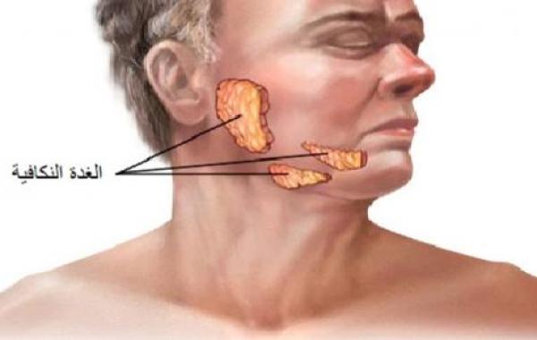 التهاب الغدة النكافية