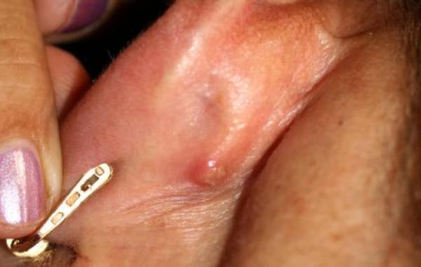 التهاب الغدد اللمفاوية خلف الأذن