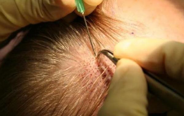 طريقة زراعة الشعر