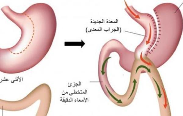 تحويل مسار المعدة